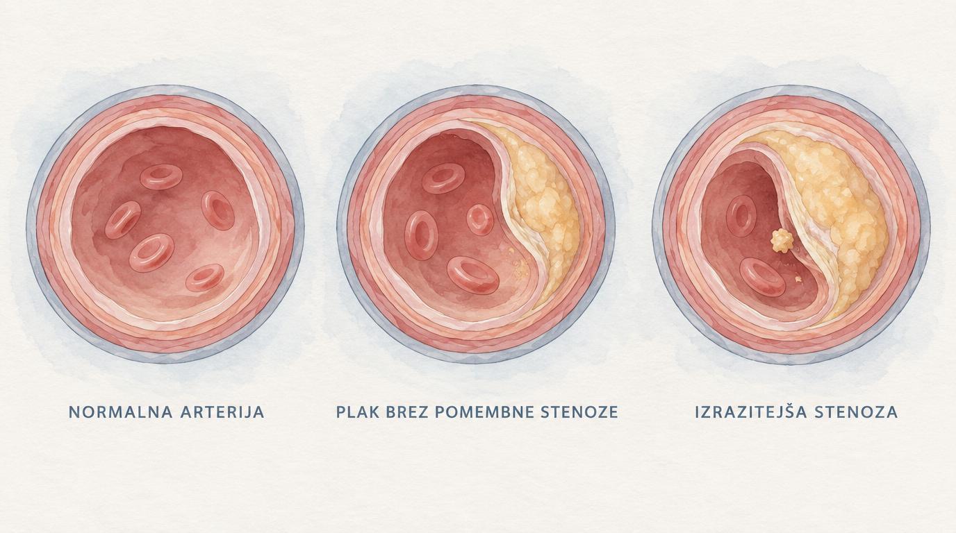 Primerjava normalne karotidne arterije, plaka brez pomembne stenoze in izrazitejše stenoze